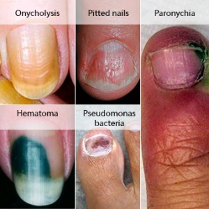 Nail disorders